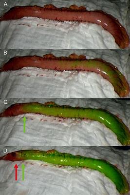 Efficacy of Indocyanine Green Fluorescence Angiography in Preventing Anastomotic Leakage After McKeown Minimally Invasive Esophagectomy